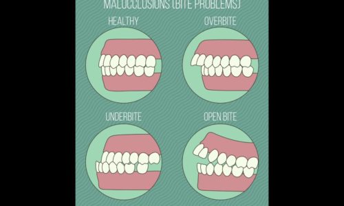 Different Types of Malocclusions