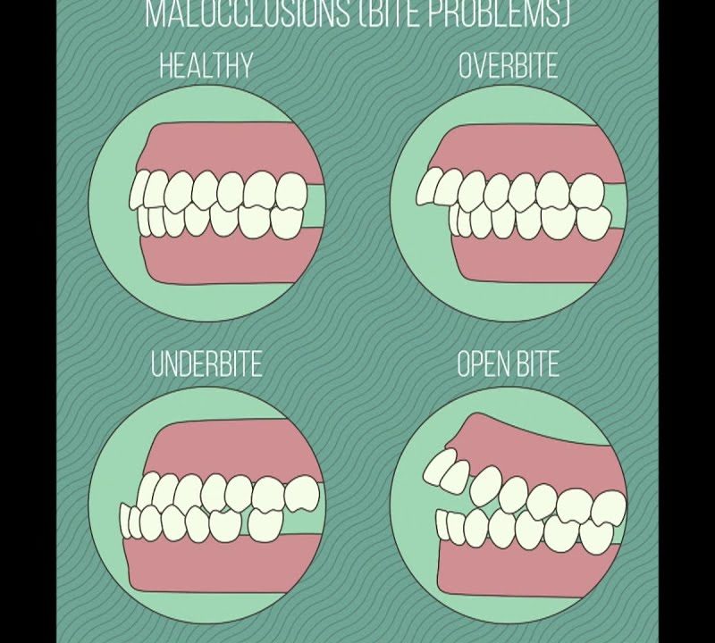 Different Types of Malocclusions