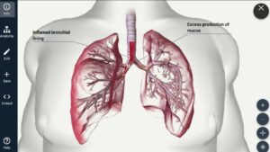 The Effects in Smoker Lungs