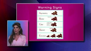 Melanoma: Warning Signs