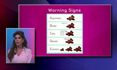 Melanoma: Warning Signs