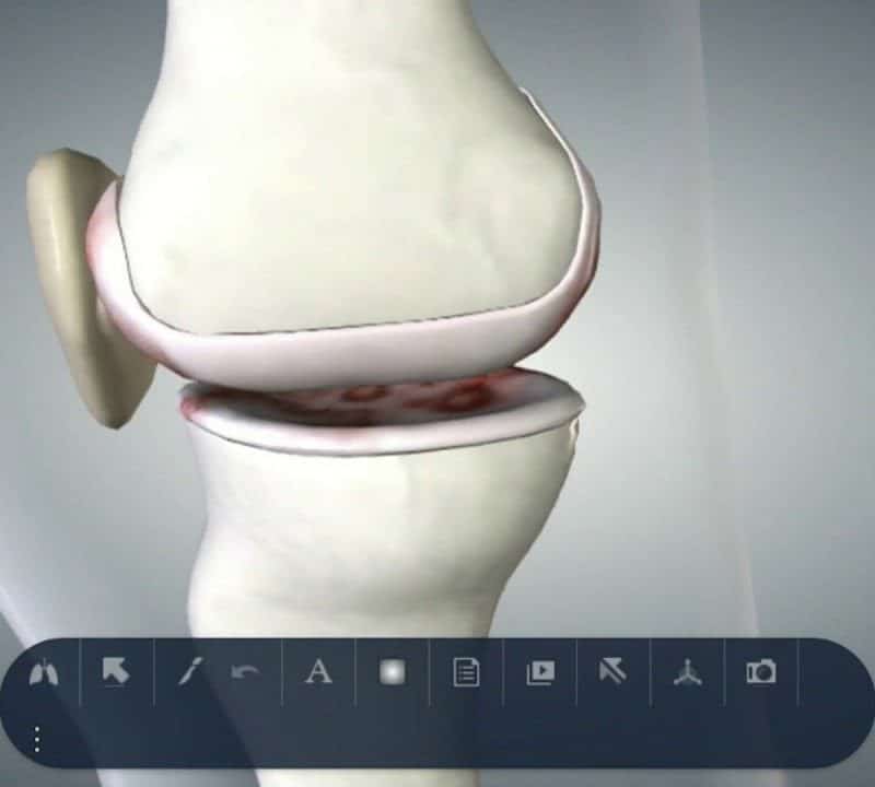 Anatomy of Knee Arthritis