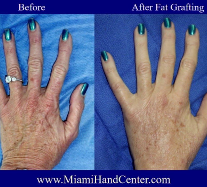 Hand Rejuvenation: Before and After