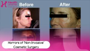 The horrors of ‘non invasive’ Plastic and Cosmetic Surgery.