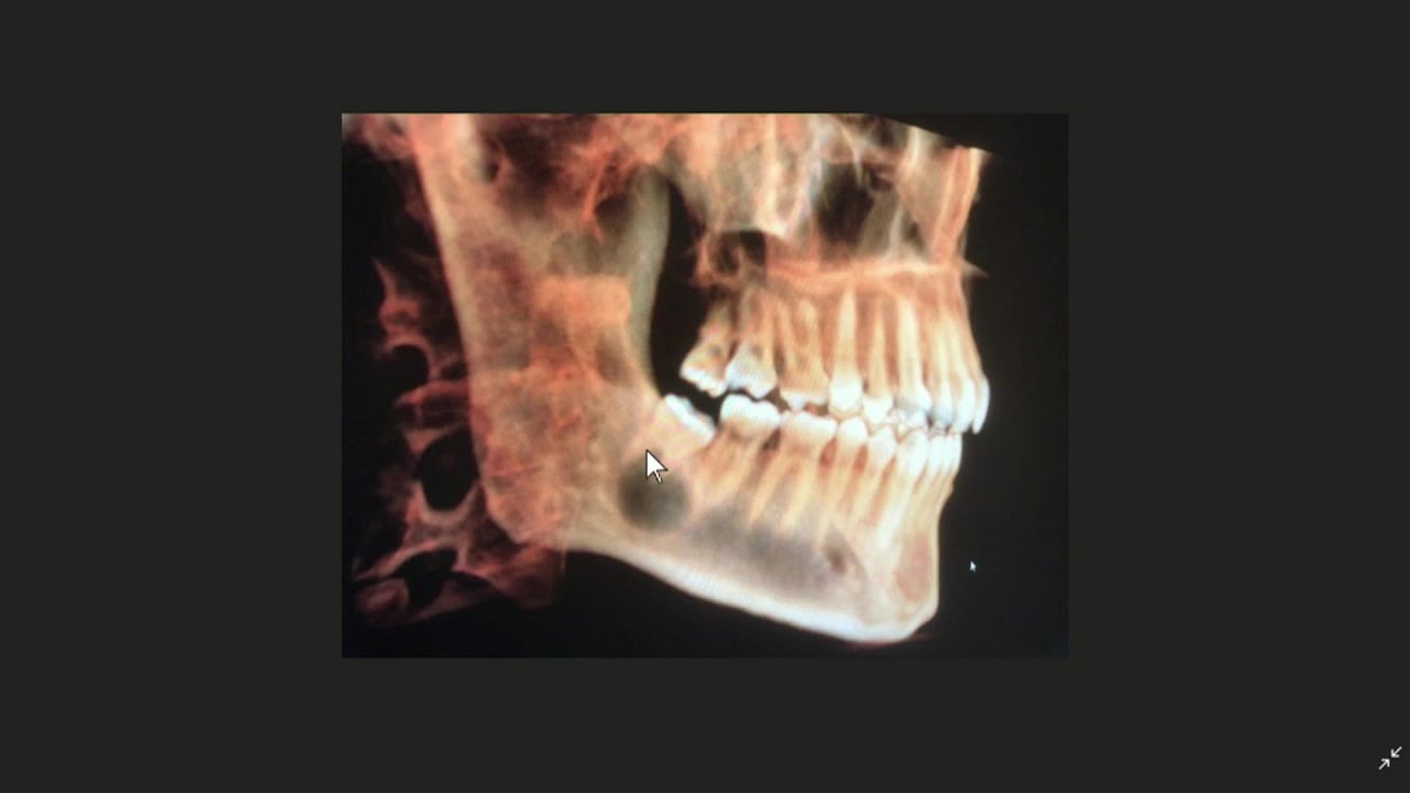 impacted teeth xray