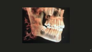 Impacted Wisdom Teeth: X-Ray View