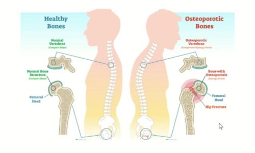 Osteoporosis & Spinal Fractures