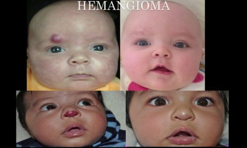 Laser Skin Treatment on Babies