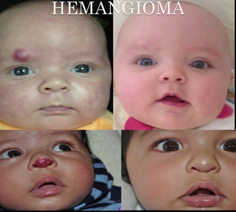 Laser Skin Treatment on Babies