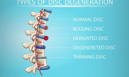 Types of Disc Herniation