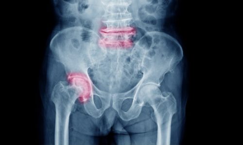 Osteoarthritis in the Hips