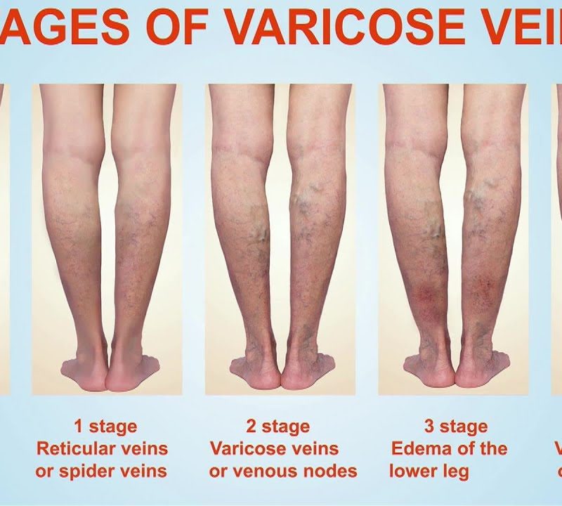 Stages of Varicose Veins
