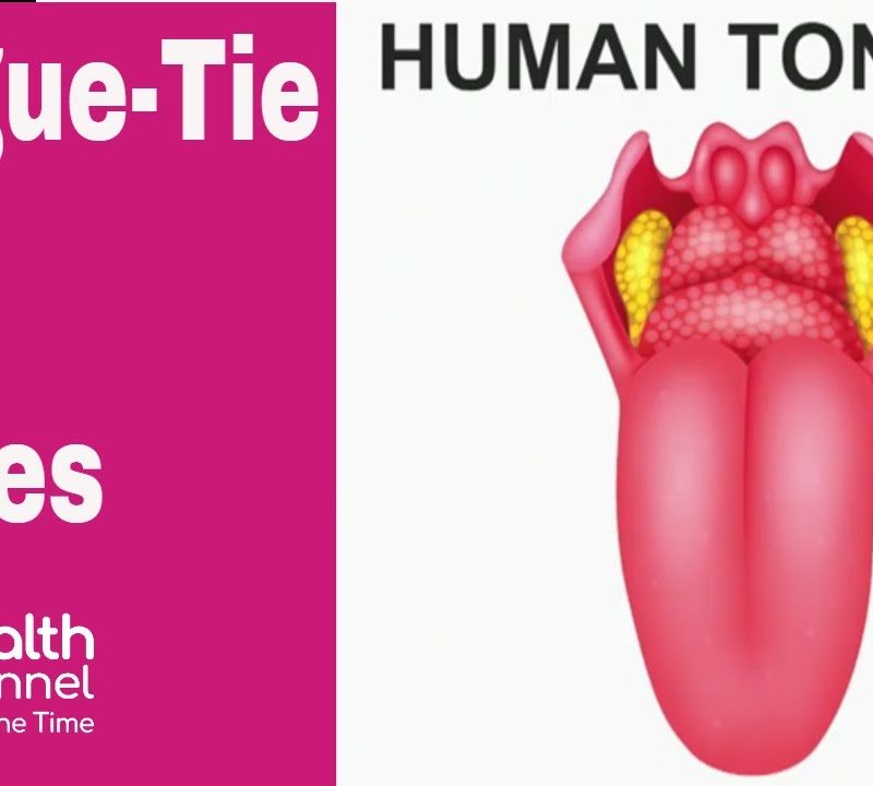Tongue-Tie in Babies