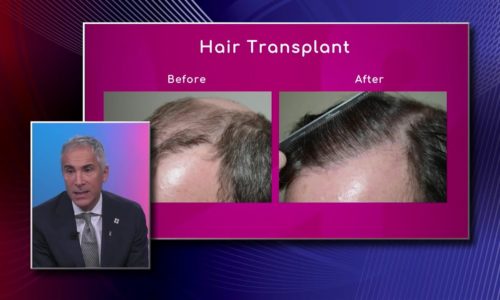 Hair Transplant Results