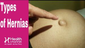 Types of Hernias with Dr. Anthony Gonzalez