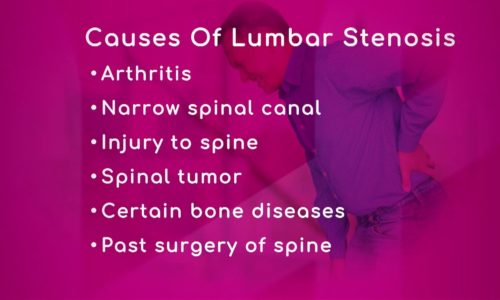 Causes of Lumbar Spinal Stenosis