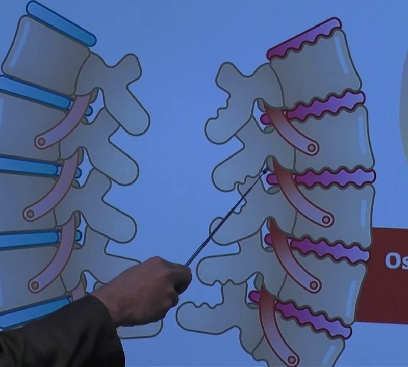 Anatomy of Spine: Osteoarthritis