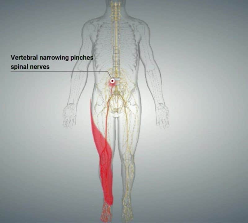 Causes of Spinal Stenosis