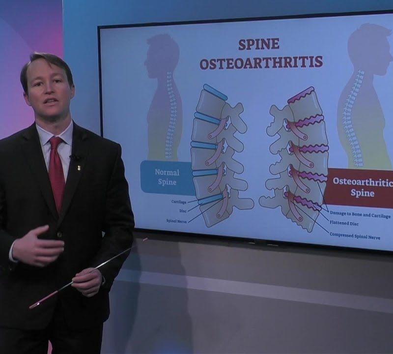 Spine and Osteoarthritis