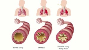 Consequences of Asthma