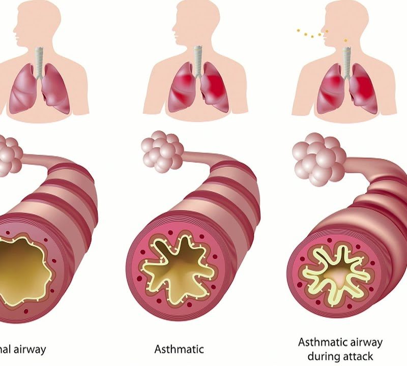 Consequences of Asthma