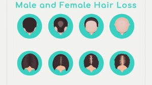 Hormone Replacement and Hair Loss