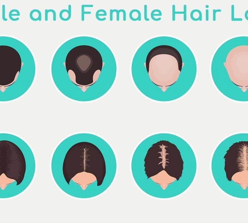 Hormone Replacement and Hair Loss