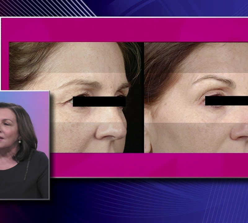 Radiofrequency: Before and After