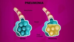 How Pneumonia Looks Like?