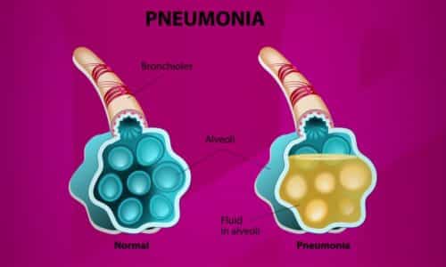 How Pneumonia Looks Like?