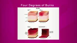 Four Degrees of Burns