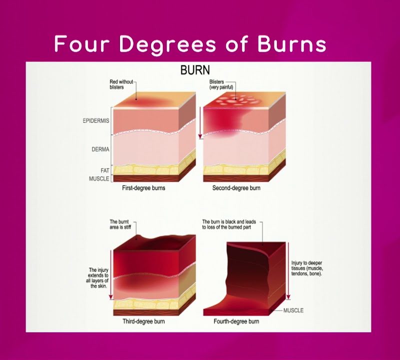 Four Degrees of Burns