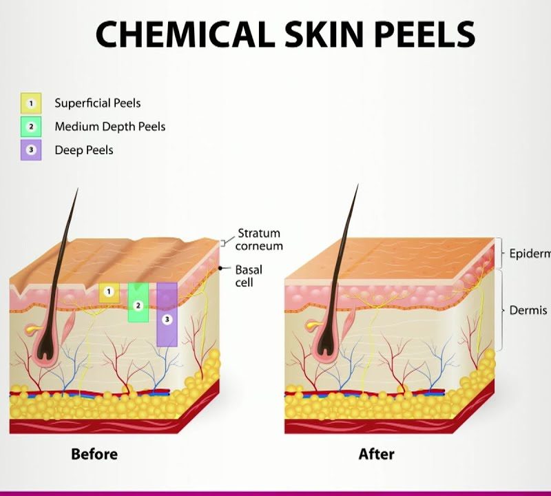 Chemical Peel: Purpose & Types