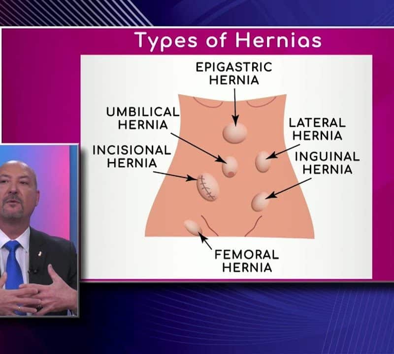 Types of Hernias with Dr. Juan-Carlos Verdeja