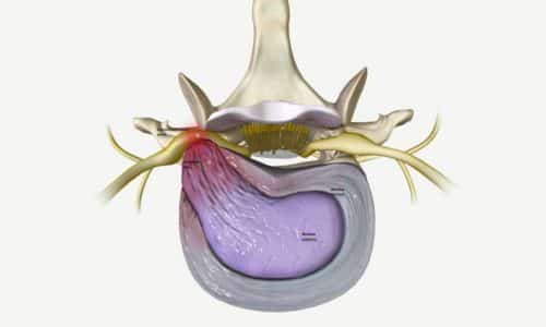 Back Pain: Herniated Disk Explained