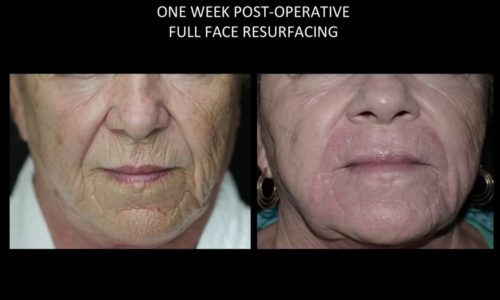 Wrinkle & Skin Tightening Procedure