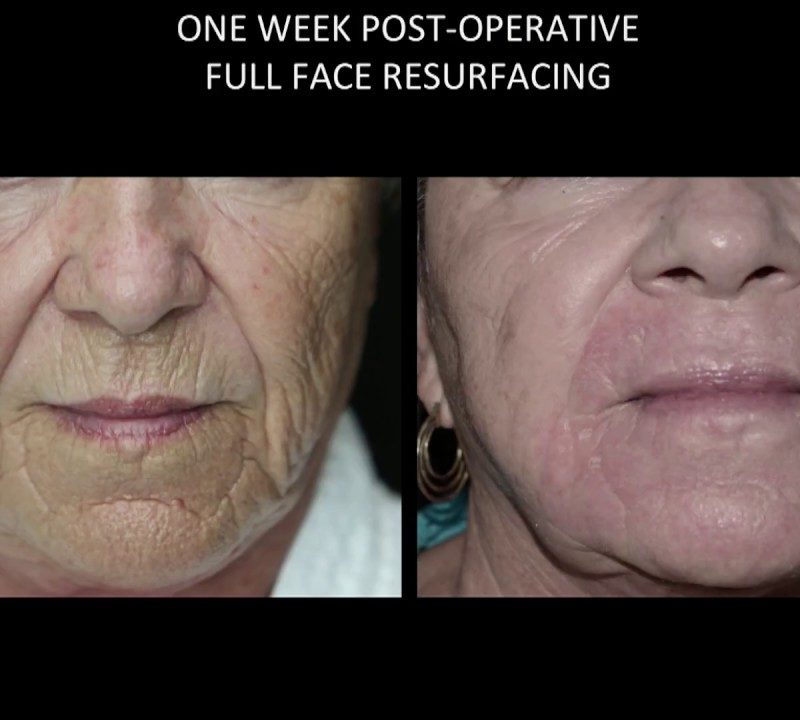 Wrinkle & Skin Tightening Procedure
