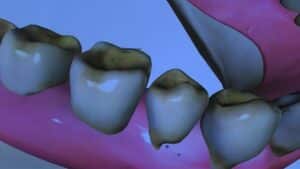 Causes and Symptoms of Tooth Decay