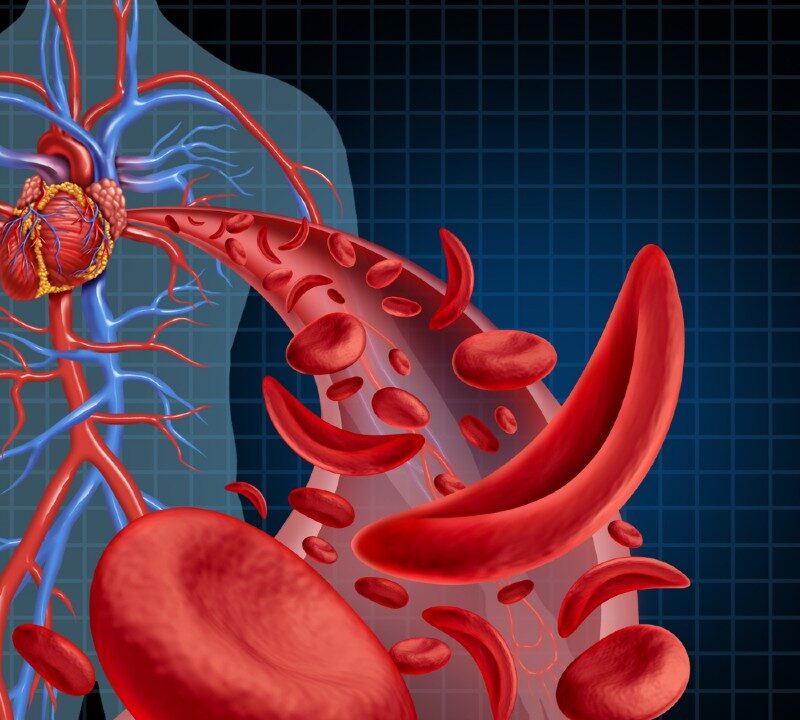 A Breakthrough in Sickle Cell Disease