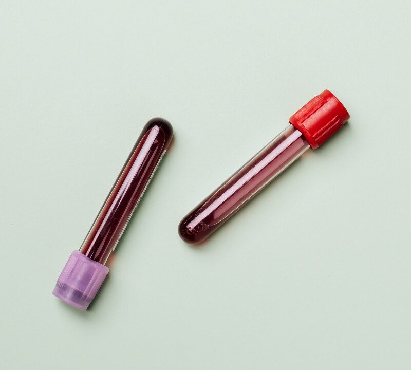 A New Non-Surgical Treatment for Prostate Cancer