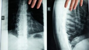 New Scoliosis Surgery