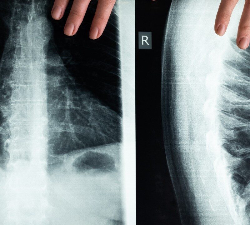 New Scoliosis Surgery