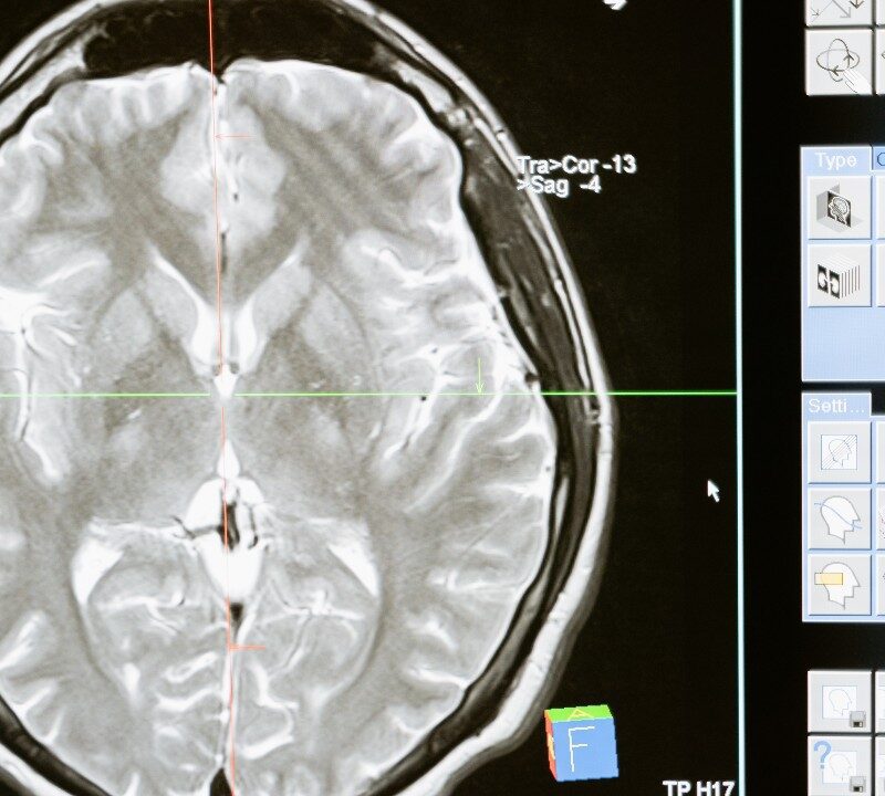 Radioactive Seeds That Battle Brain Cancer