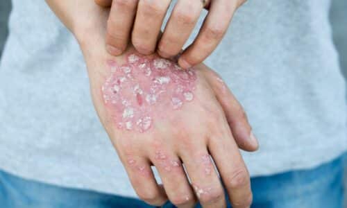 Hope for Psoriasis