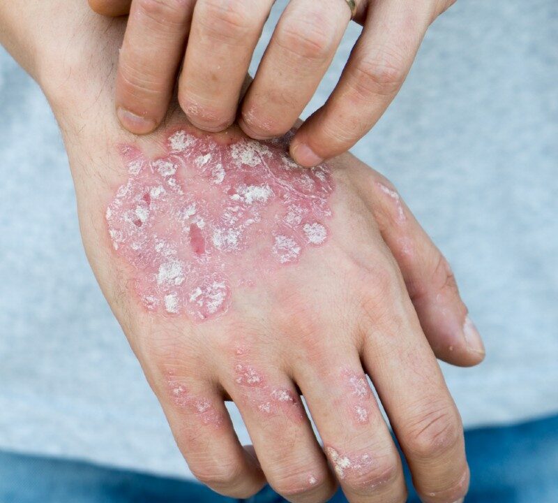 Hope for Psoriasis