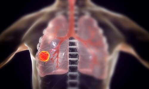 Why You Should Know About Lung Cancer