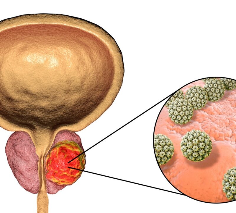 Exercise and Prostate Cancer
