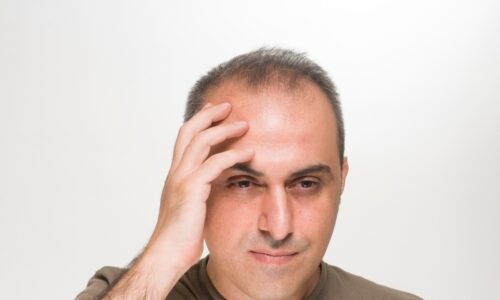 Help for Male Pattern Baldness