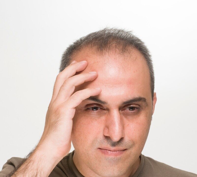 Help for Male Pattern Baldness