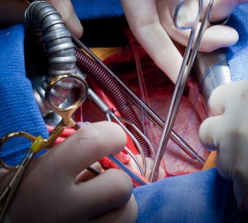 A Little Life Saved by Heart Surgery in the Womb
